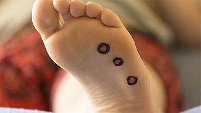 Wart on a foot, Plantar wart on foot symptoms Foot wart nerve pain